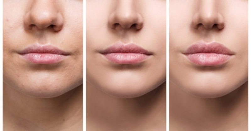 Clínica de Preenchimento Labial Praça Da Árvore - Preenchimento Labial Masculino