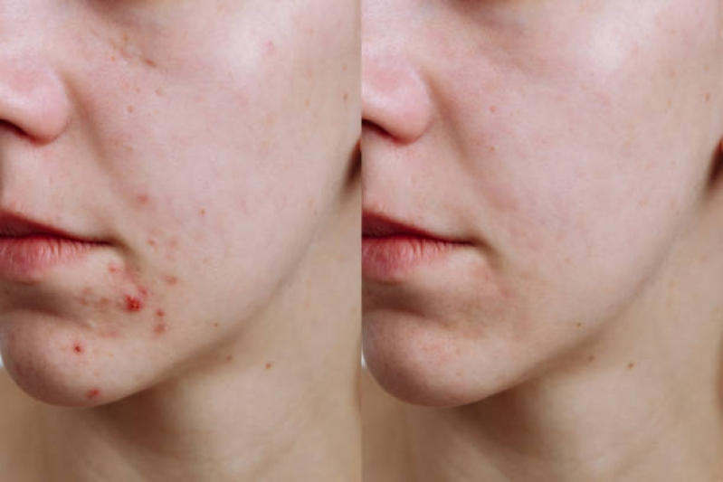 Clínica para Tratamento Acne Comprimidos Vila Madalena - Tratamento para Acne Hormonal