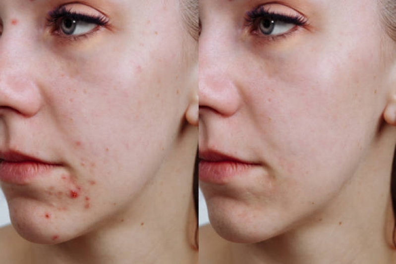 Clínica para Tratamento Acne Saúde - Tratamento para Manchas de Acne