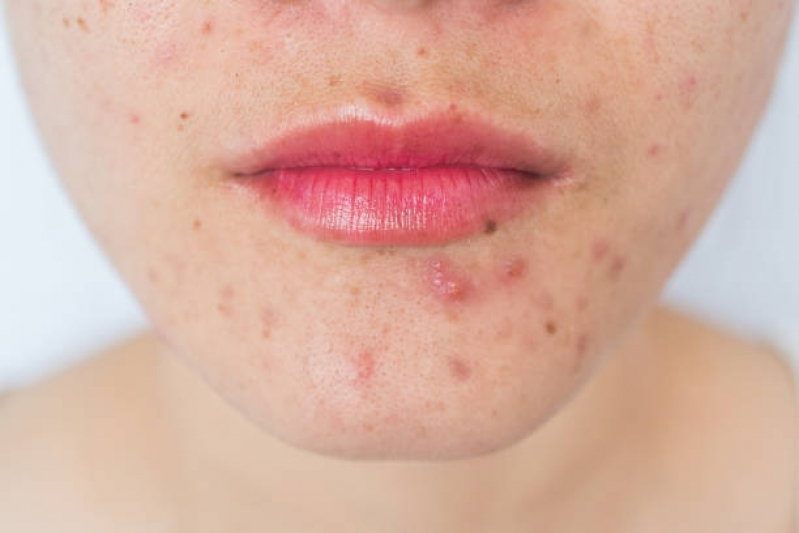 Clínica para Tratamento contra Acne Saúde - Tratamento contra Acne