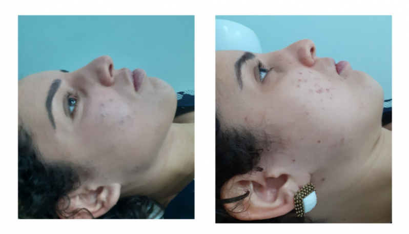 Clínica para Tratamento para Manchas de Acne Vila Mariana - Tratamento para Acne