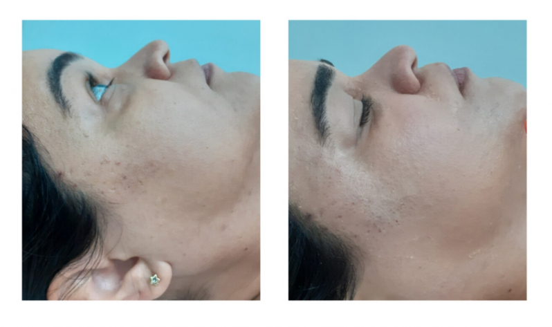 Clínica para Tratamento para Marcas de Acne Praça Da Árvore - Tratamento contra Acne