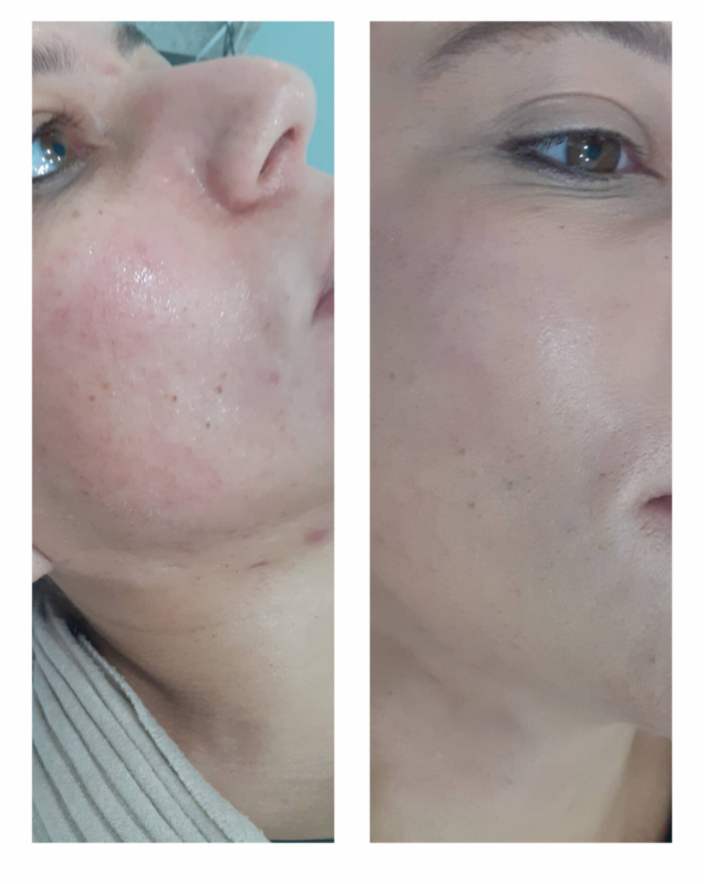 Limpeza de Pele com Acne Valor Vila Mariana - Limpeza de Pele Cravos e Espinhas