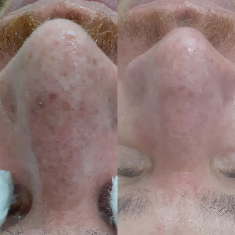 Limpeza de Pele Costas Valor Bela Vista - Limpeza de Pele com Acne