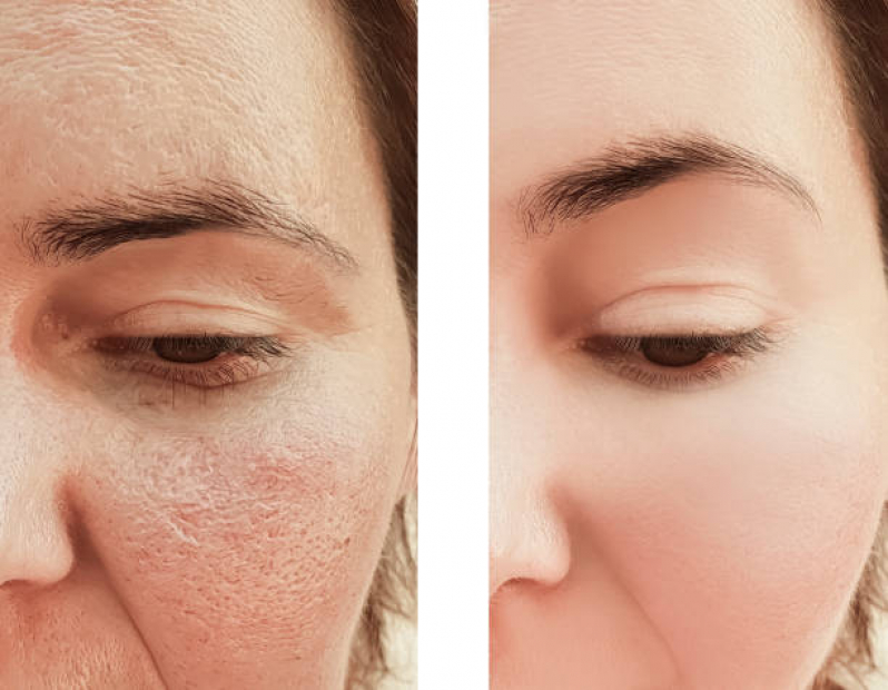 Limpeza de Pele Cravos e Espinhas Valor Ana Rosa - Limpeza de Pele com Acne