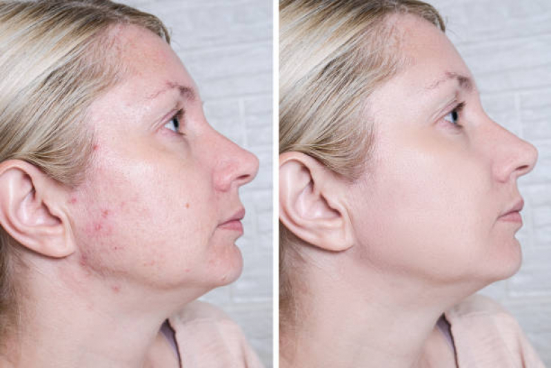 Limpeza de Pele Facial Higienópolis - Limpeza de Pele com Acne