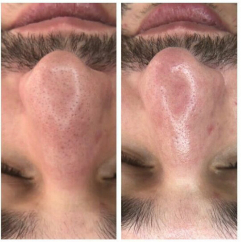 Onde Fazer Limpeza de Pele com Acne Bela Cintra - Limpeza de Pele com Acne