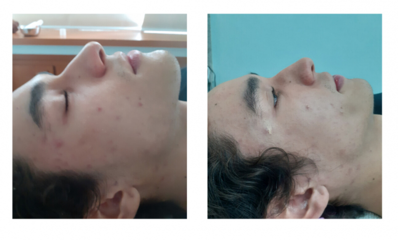 Onde Fazer Limpeza de Pele Profunda Chácara Klabin - Limpeza de Pele com Acne