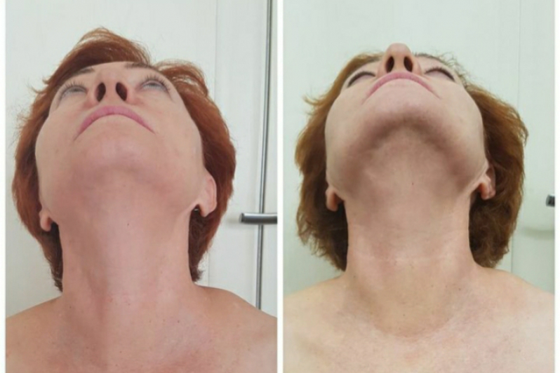 Onde Fazer Rejuvenescimento para Blefaroplastia Bela Vista - Rejuvenescimento Natural do Rosto