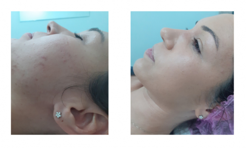 Onde Fazer Tratamento Cicatriz Acne Vila Mariana - Tratamento de Acne