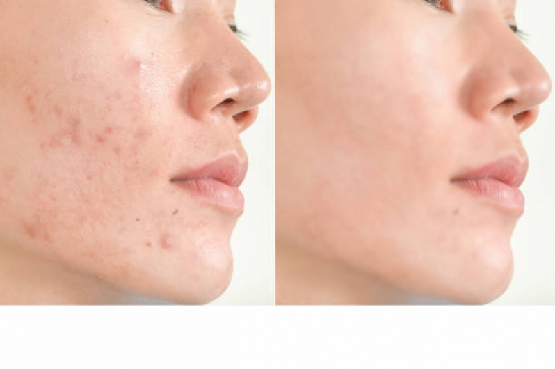 Onde Fazer Tratamento contra Acne Higienópolis - Tratamento Acne Comprimidos