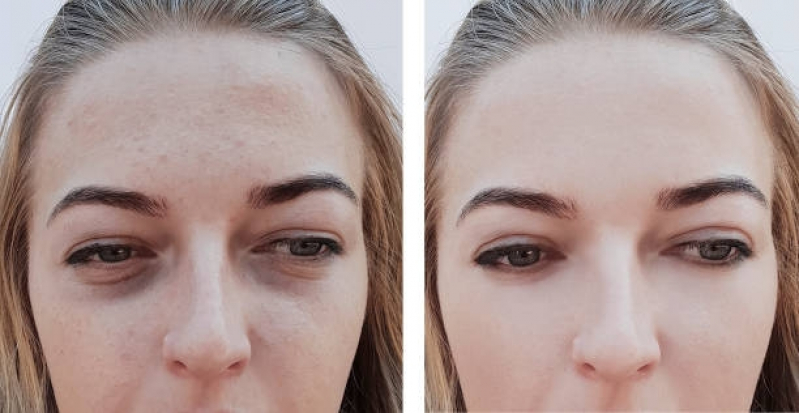 Onde Fazer Tratamento para Acne e Manchas Jardins - Tratamento a Laser para Acne