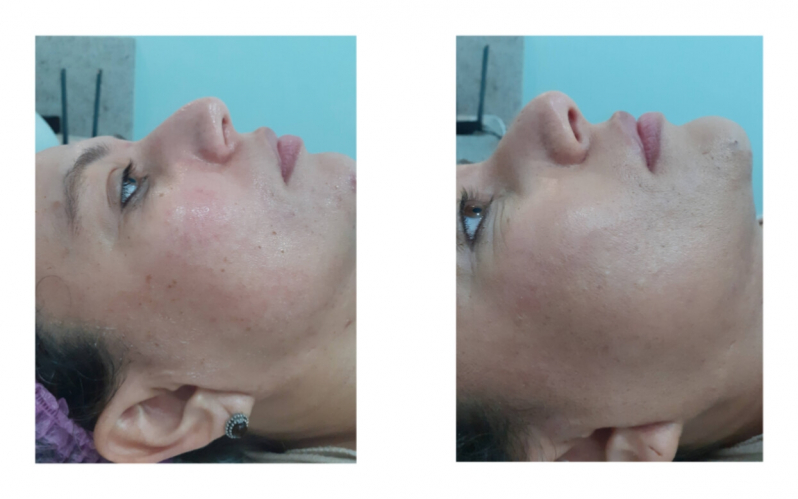 Onde Fazer Tratamento para Acne Hormonal Chácara Klabin - Tratamento para Acne Hormonal