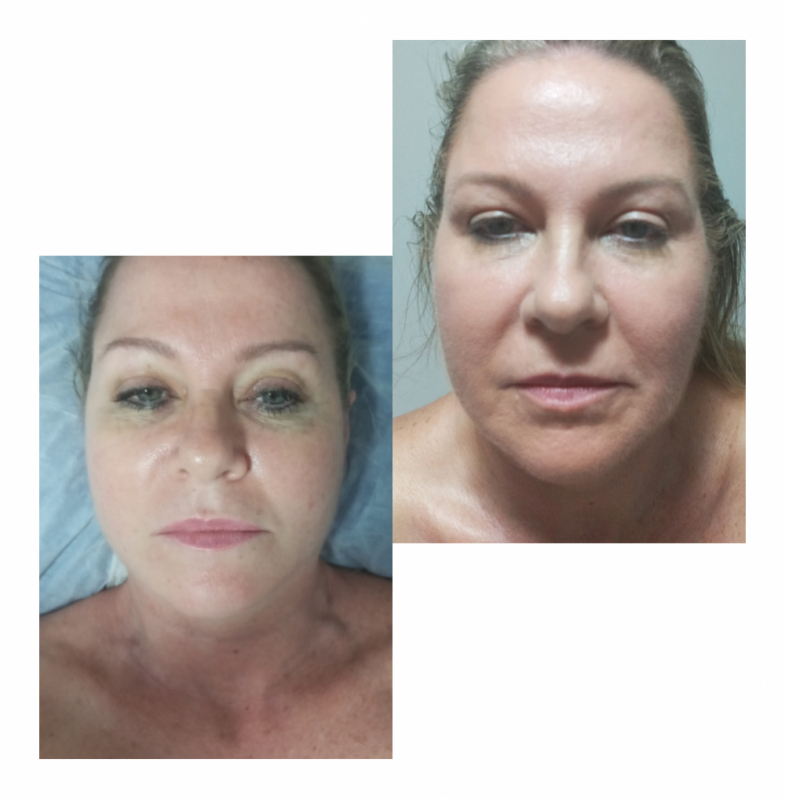 Rejuvenescimento para Blefaroplastia Higienópolis - Rejuvenescimento Natural do Rosto