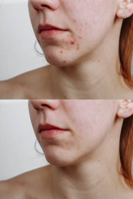 Tratamento Acne Agendar Bela Cintra - Tratamento contra Acne