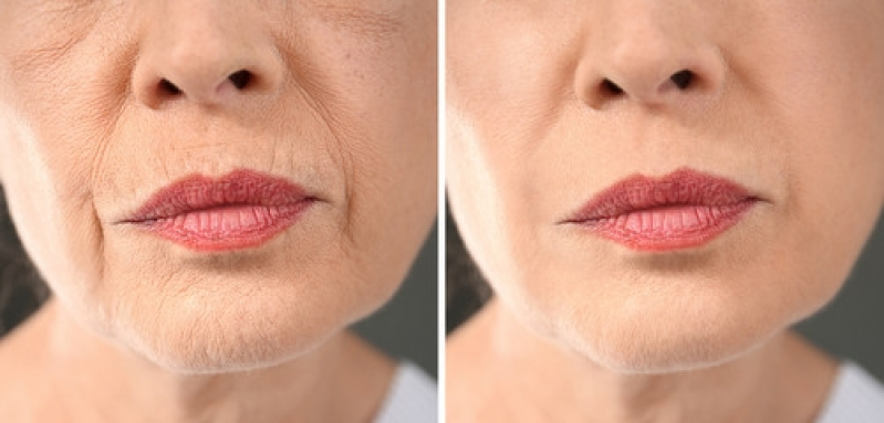 Tratamento de Preenchimento Labial Bela Cintra - Preenchimento Labial Masculino