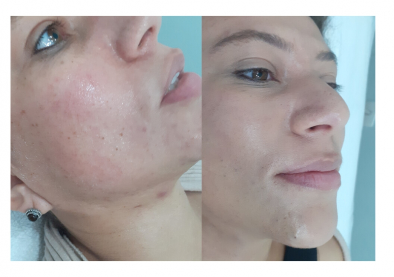 Tratamento para Acne Hormonal Agendar Bela Vista - Tratamento a Laser para Acne